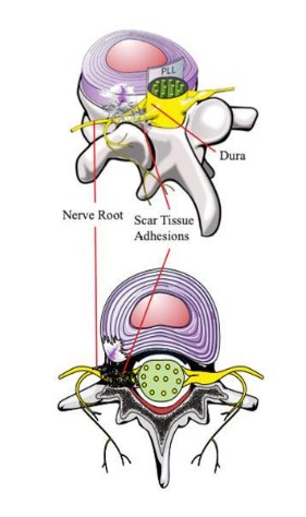 신경근 유착(Scar Tissue Adhesions) 모식도